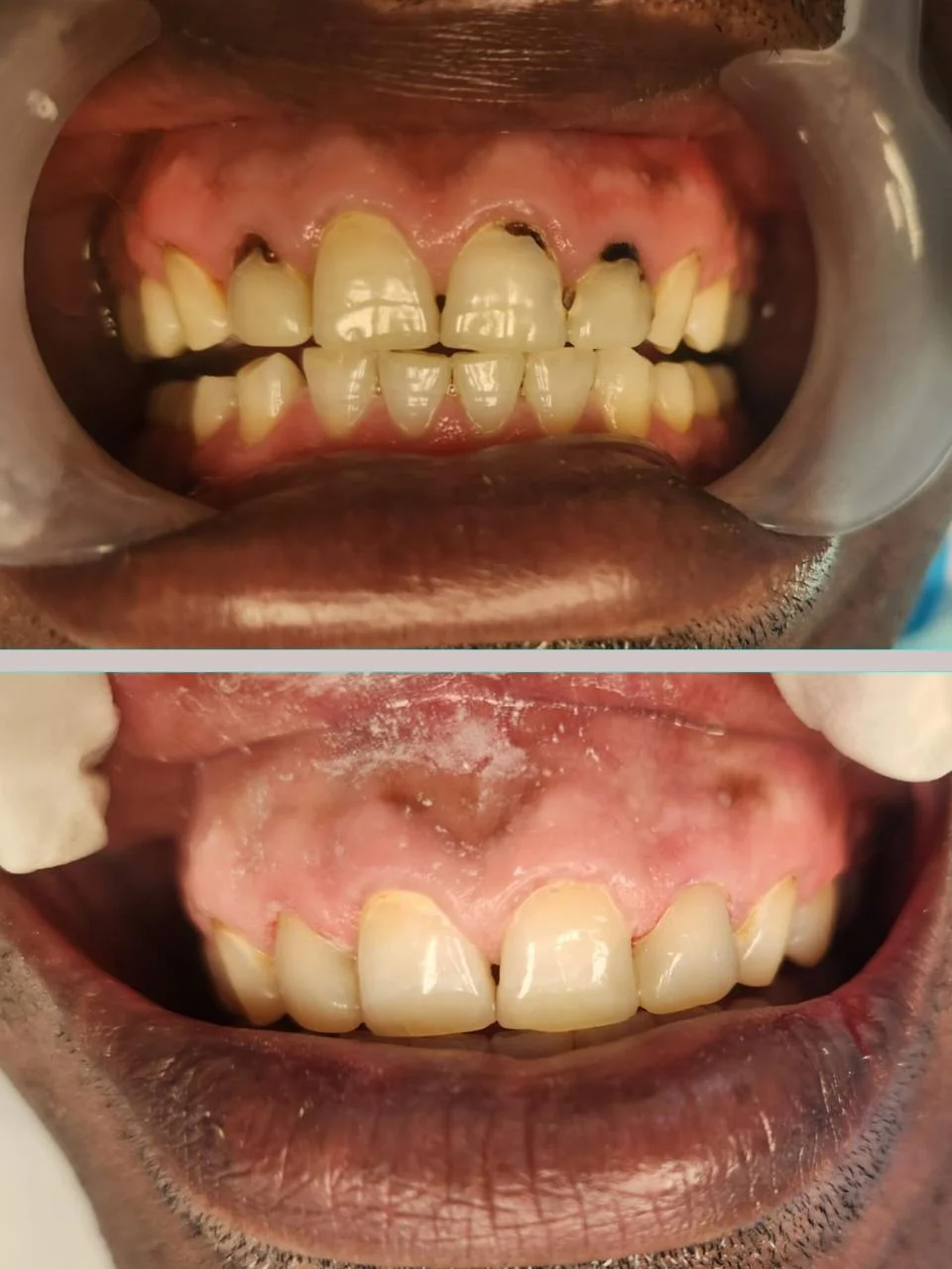 Before and after: decay removal and crown restoration
